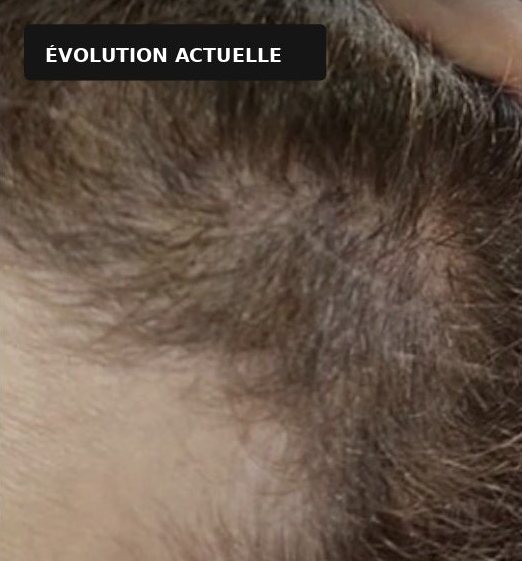 Cuir chevelu de Claire, évolution actuelle