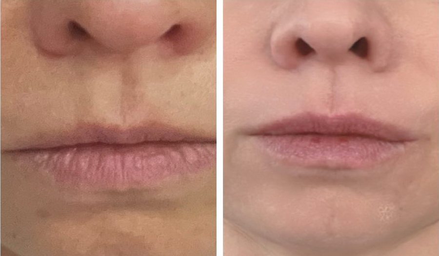La peau autour de la bouche à 41 ans et à 45 ans