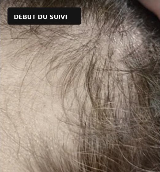 Cuir chevelu de Claire au début du suivi